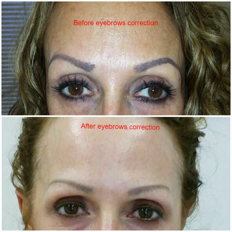 Eyebrow Microblading tattoo removal and correction repair - Eye Art Studio