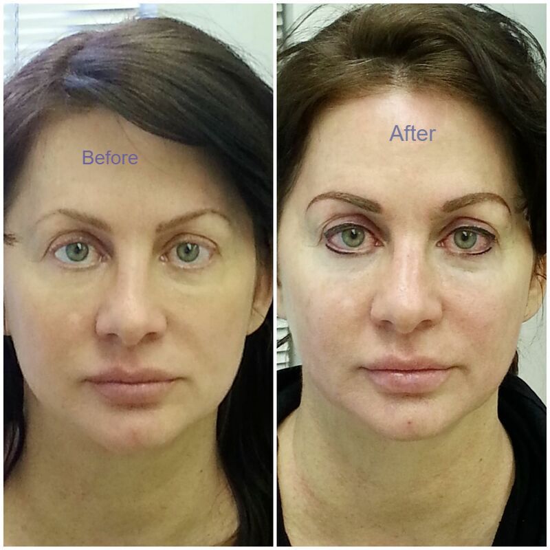 Tattooed Eyebrows Gone Wrong What Can Happen and What to Do